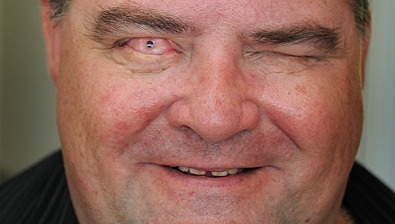 Tooth Implant Enables British Man To See Again